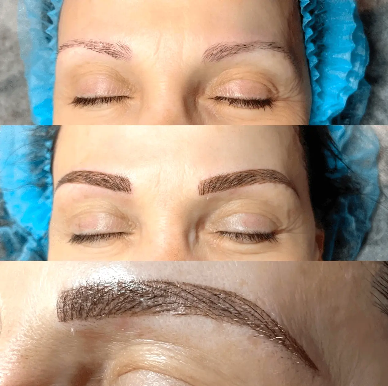 Saline Eyebrow Tattoo Removal Before And After