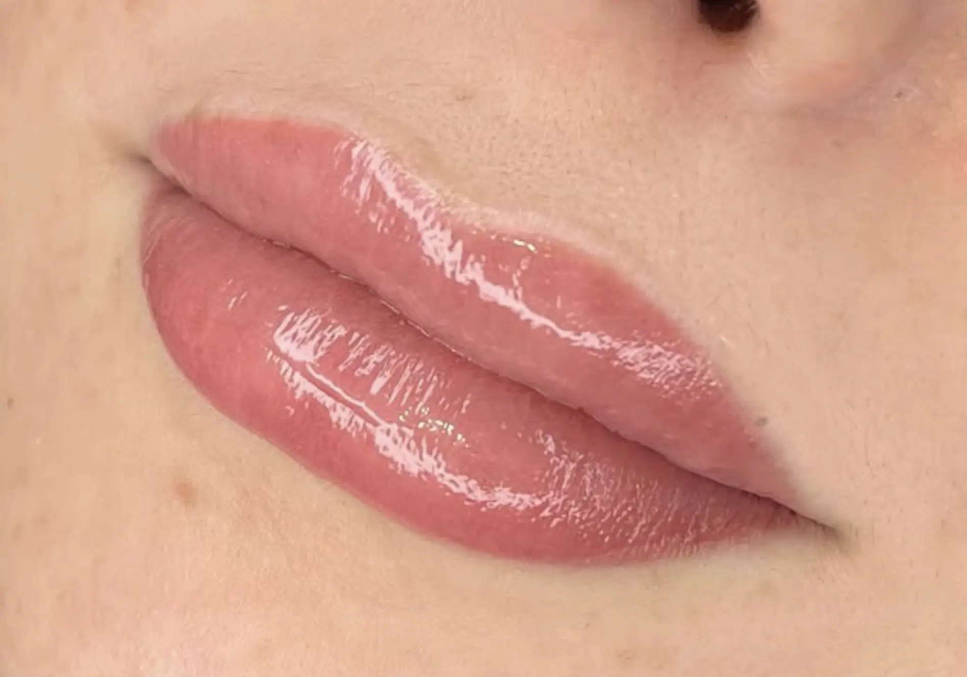 Dark lip neutralisation Brisbane