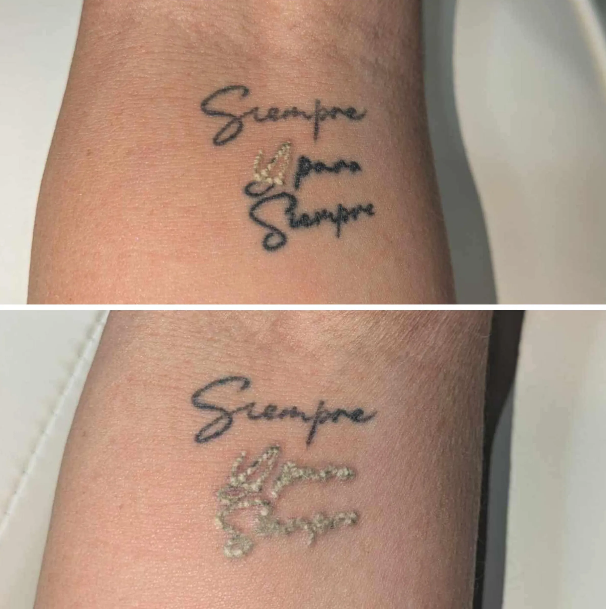 aloe vera after laser tattoo removal