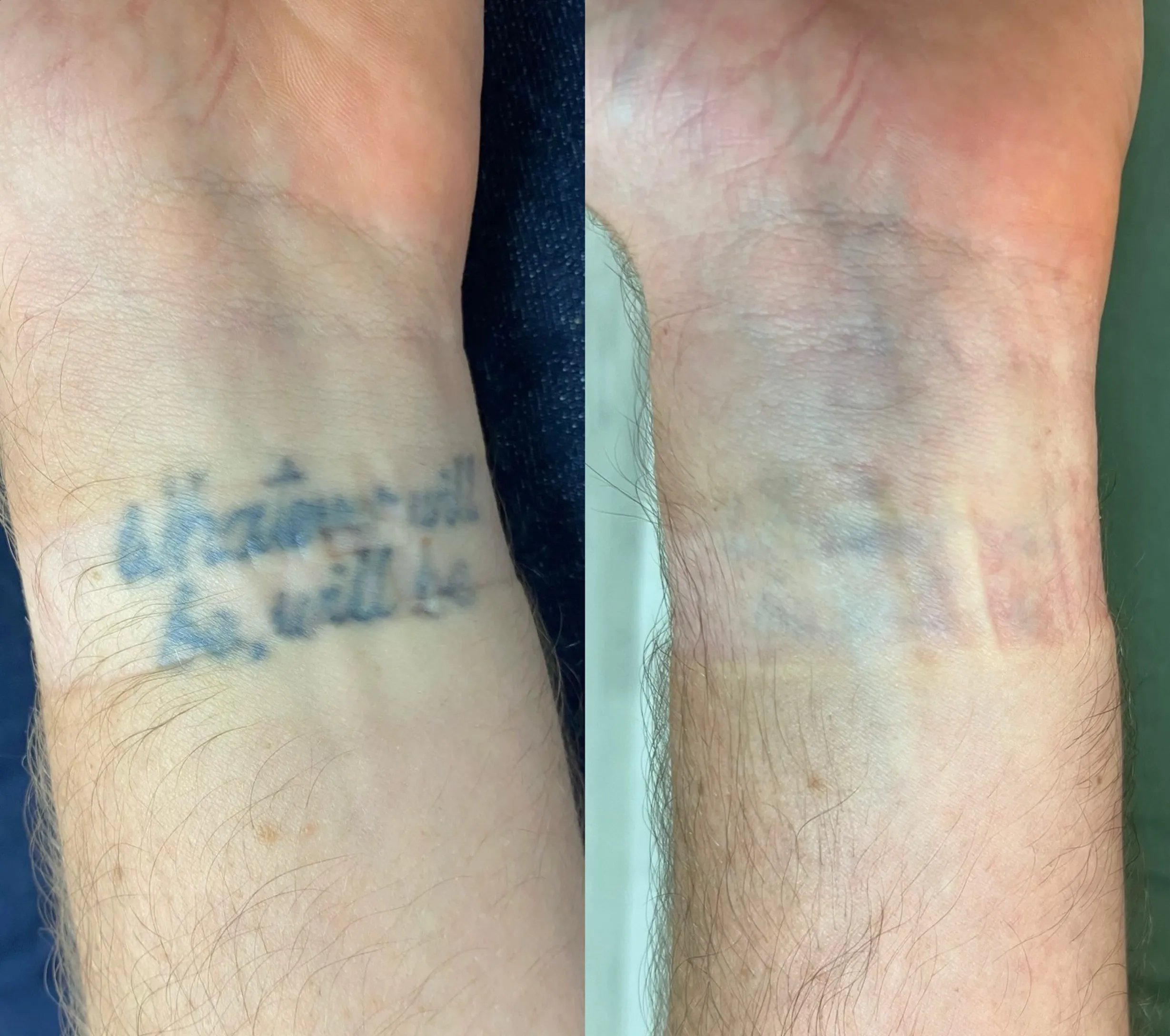 Can aloe vera fade tattoos?