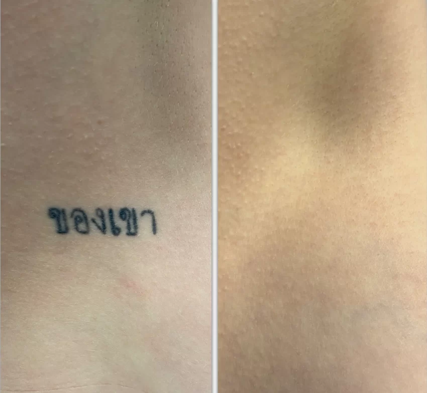 Can Aloe Vera Fade Tattoos